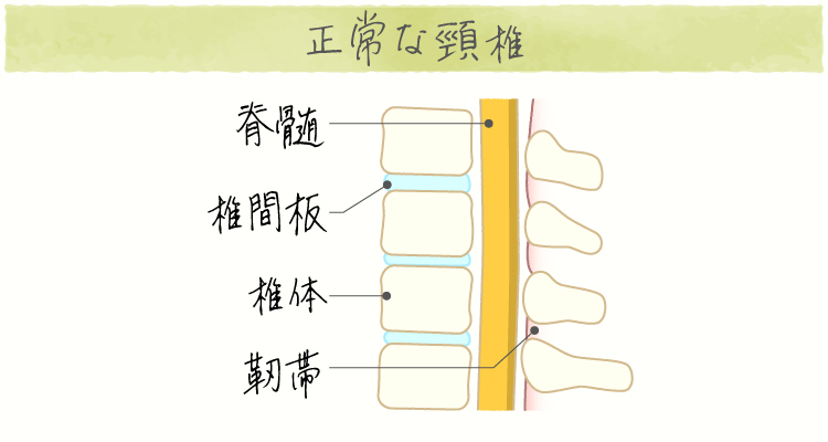 頸椎症 イメージ