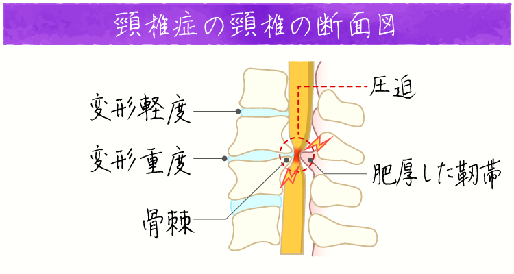 頸椎症 イメージ