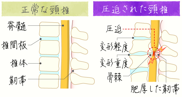 頸椎症性脊髄症 イメージ