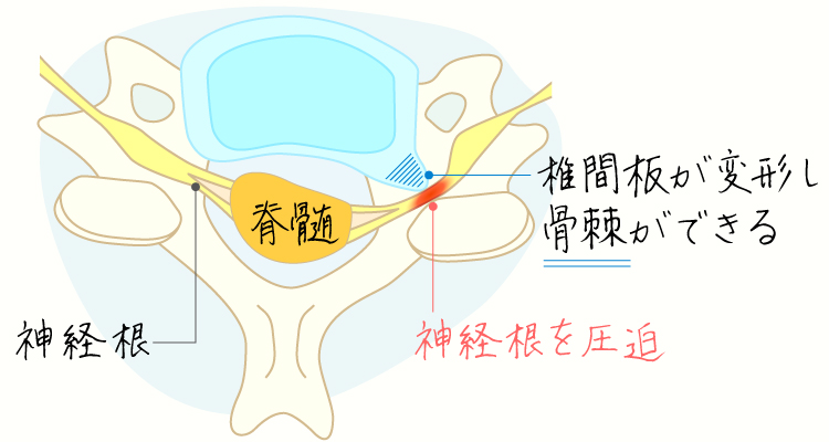 頸椎症性神経根症 イメージ