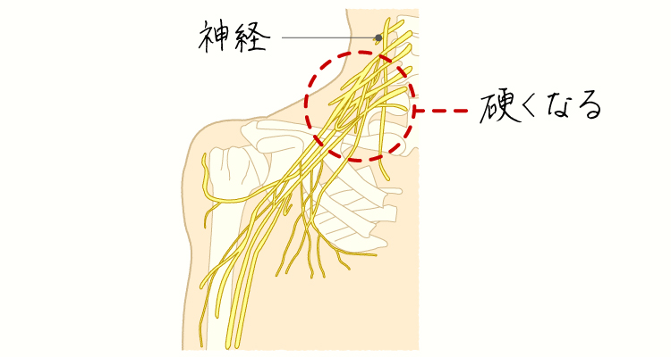 頸肩腕症候群 イメージ