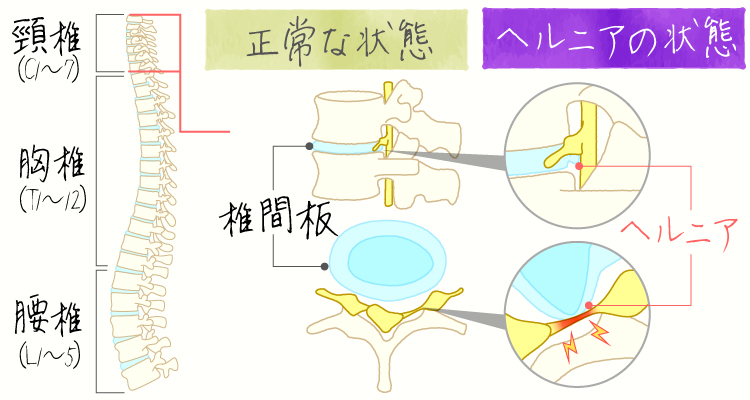 頸椎椎間板ヘルニア イメージ