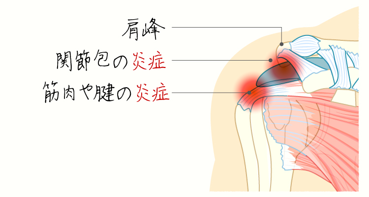 肩関節周囲炎(五十肩) イメージ