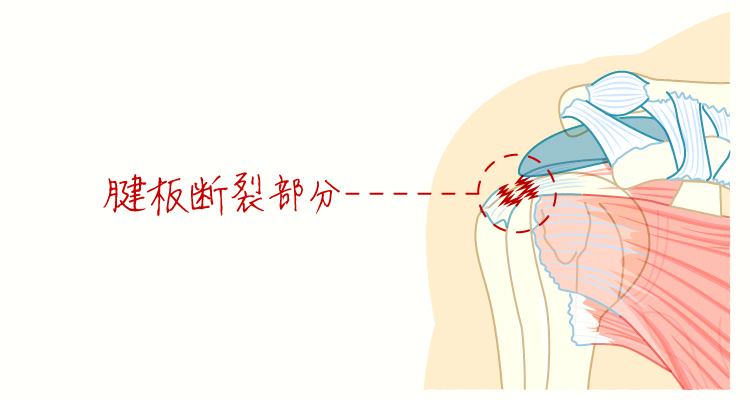 肩腱板断裂 イメージ