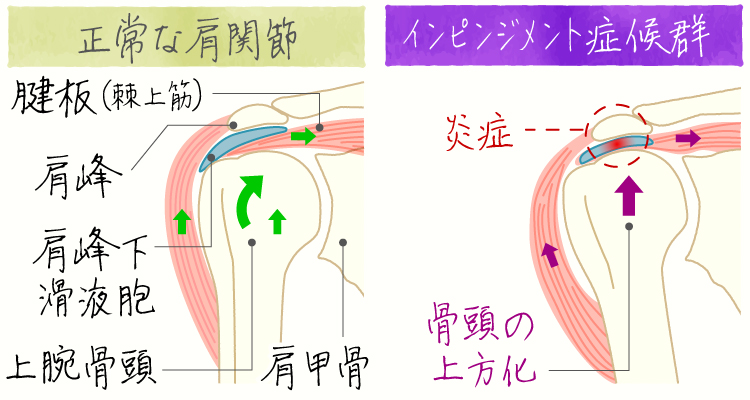 投球障害肩(野球肩) イメージ