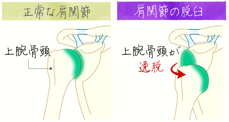 反復性肩関節脱臼 イメージ