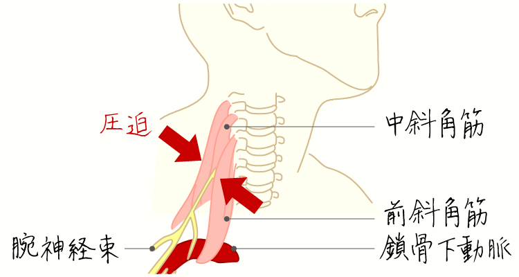 胸郭出口症候群 イメージ