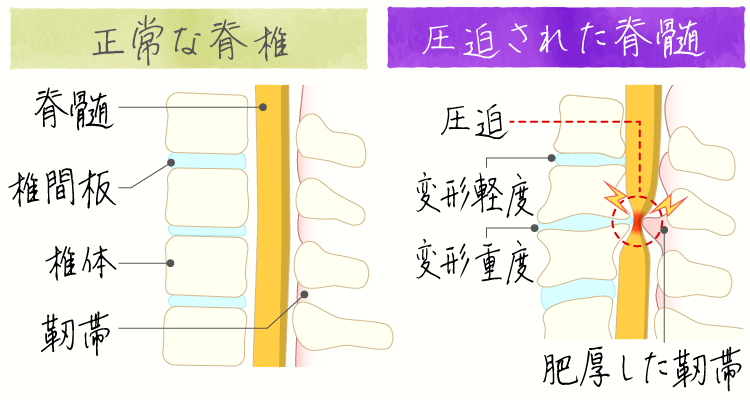 変形性脊椎症 イメージ