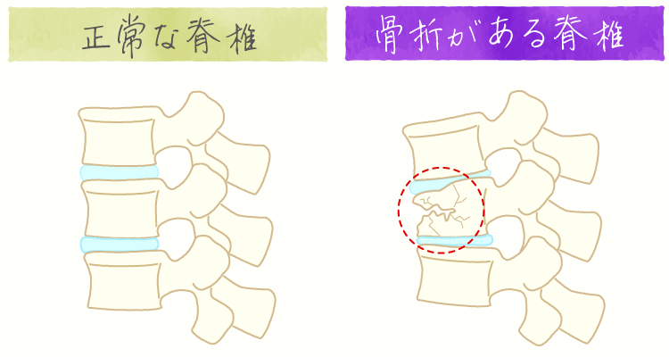 圧迫骨折 イメージ