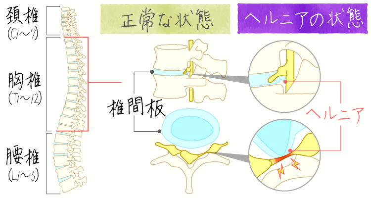 頸椎椎間板ヘルニア イメージ