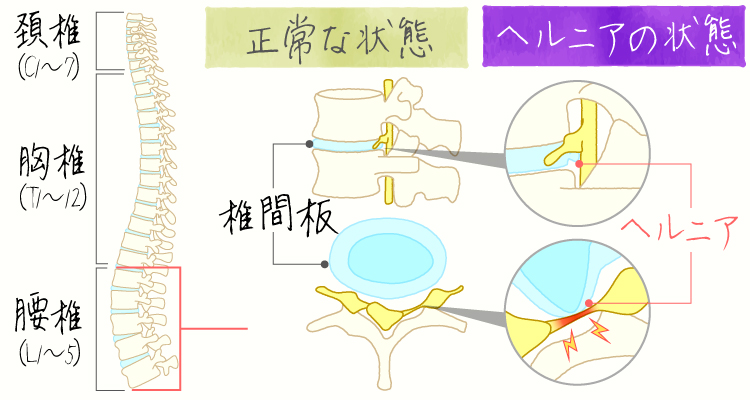 腰椎椎間板ヘルニア イメージ