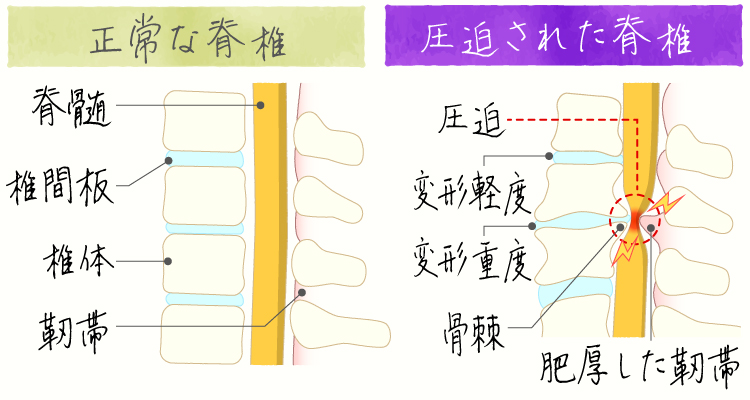 腰部変形性脊椎症 変形性腰椎症 イメージ