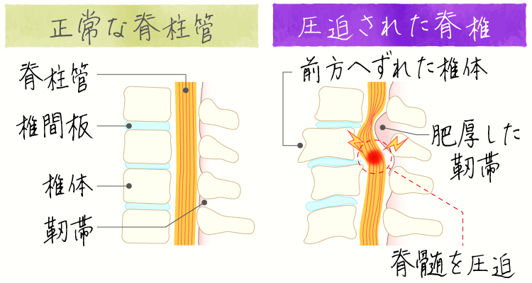 腰部脊柱管狭窄症 イメージ