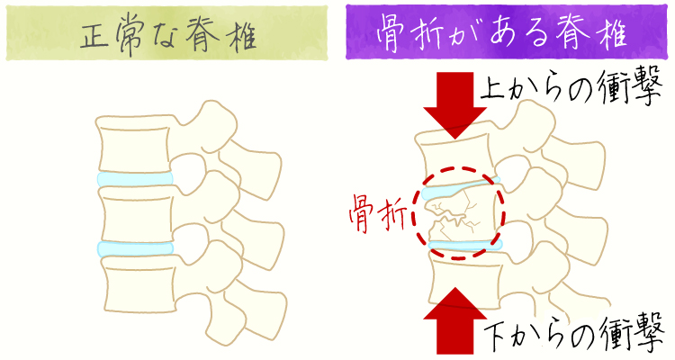 圧迫骨折 イメージ