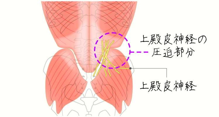 筋膜性腰痛症 イメージ