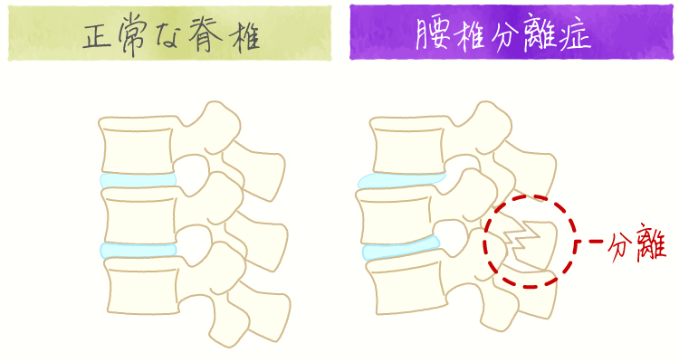 腰椎分離症 イメージ