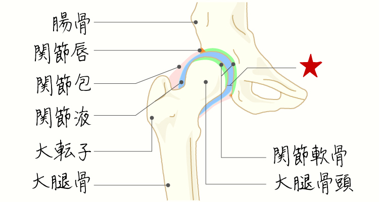 変形性股関節症 イメージ