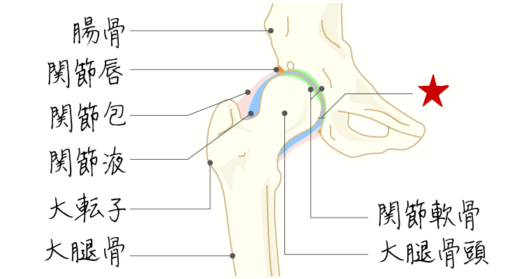 変形性股関節症 イメージ