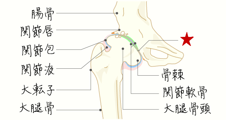 変形性股関節症 イメージ