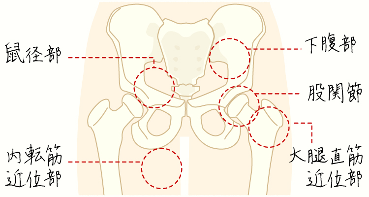 鼠径部痛症候群 イメージ