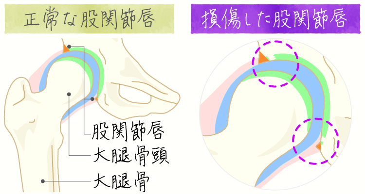 股関節唇損傷 イメージ