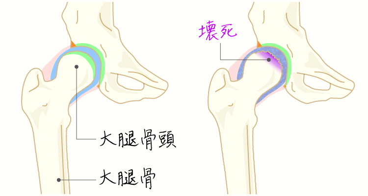 大腿骨頭壊死症 イメージ