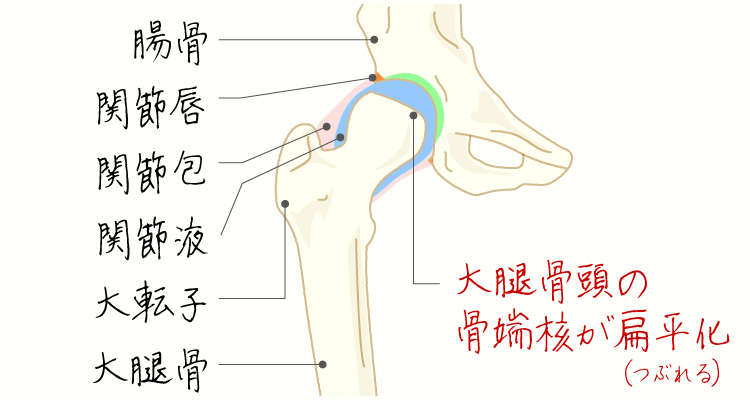 ペルテス病 イメージ
