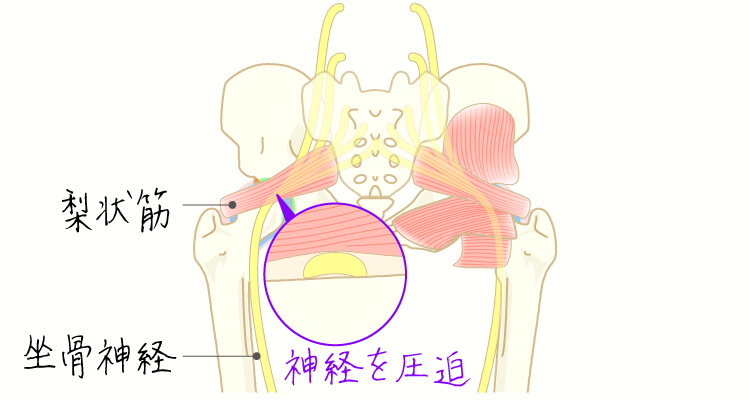 梨状筋症候群 イメージ