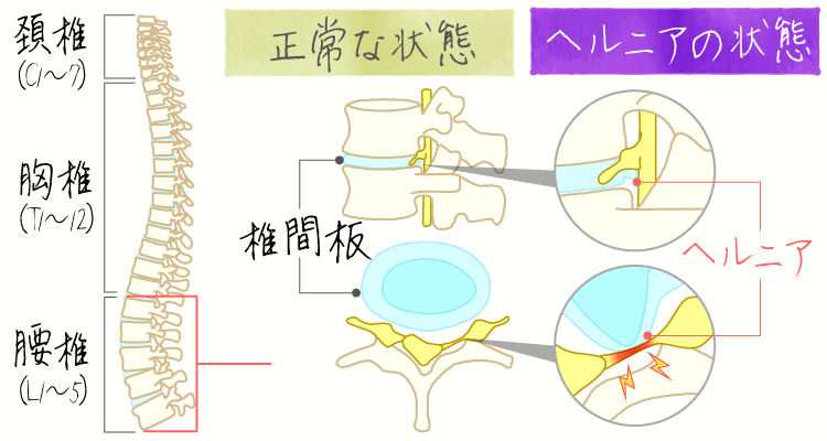 腰椎椎間板ヘルニア イメージ