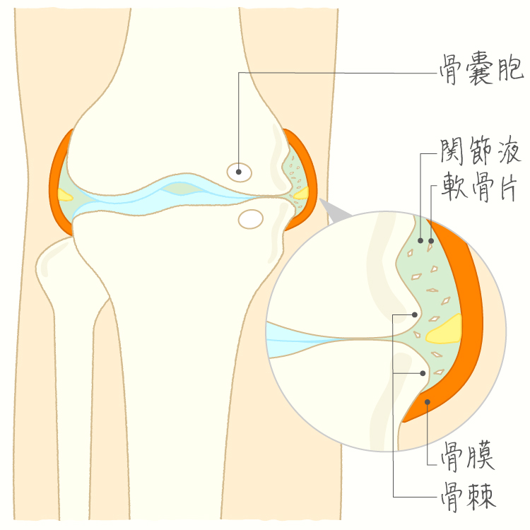 変形性膝関節症 イメージ