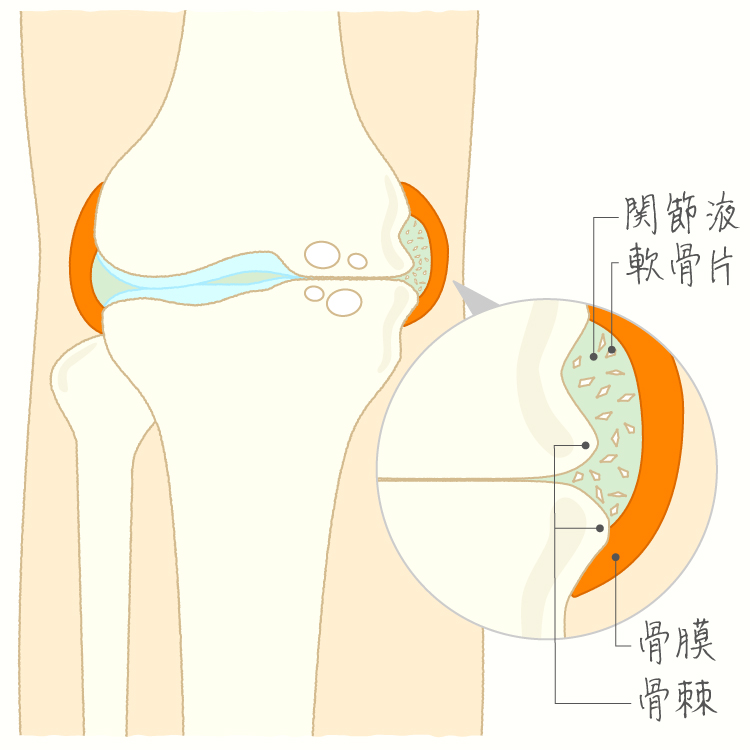 変形性膝関節症 イメージ