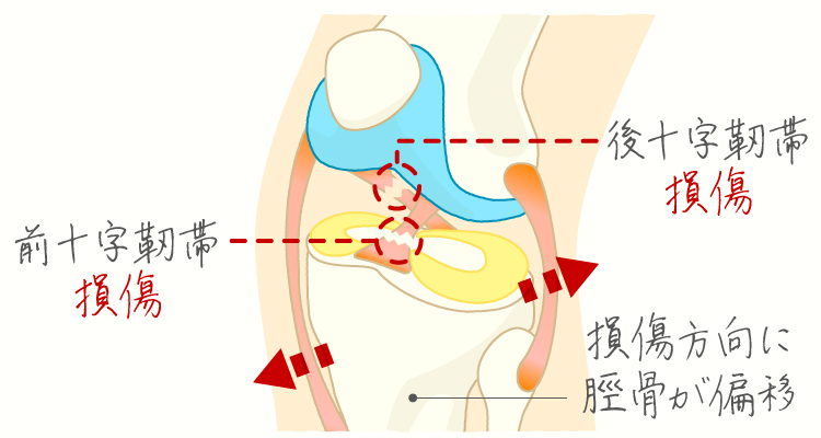 十字靭帯損傷 イメージ