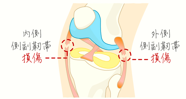 十字靭帯損傷 イメージ