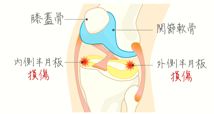 半月板損傷 イメージ