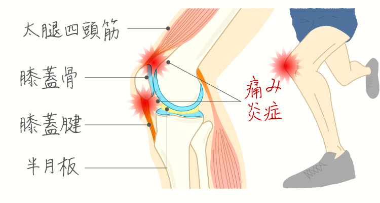ジャンパー膝 イメージ