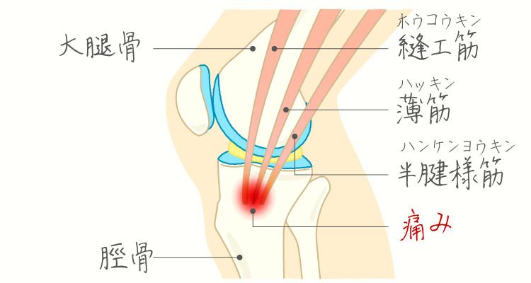 鵞足炎 イメージ