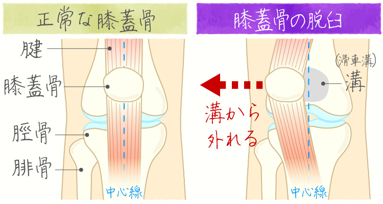 膝蓋骨脱臼 イメージ