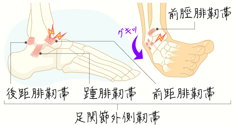 足関節靭帯損傷 (捻挫) イメージ