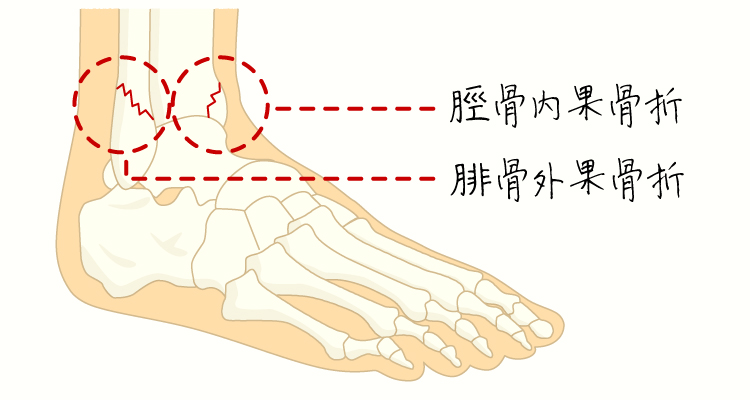 足関節周囲骨折 イメージ