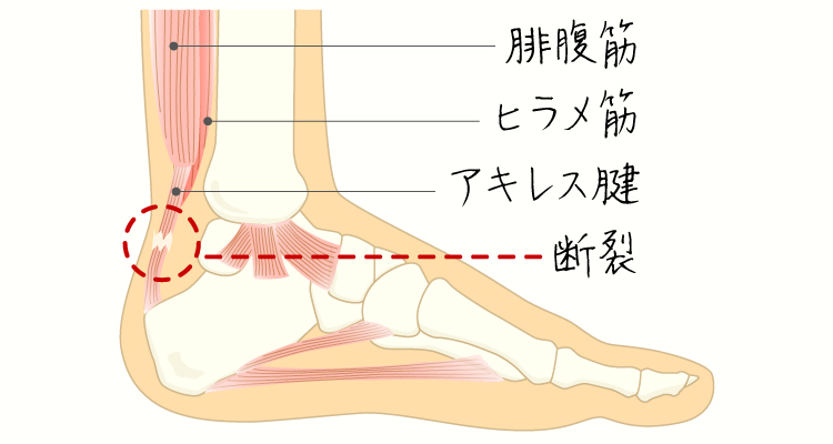 アキレス腱断裂 イメージ