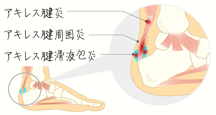 アキレス腱(周囲)炎 イメージ