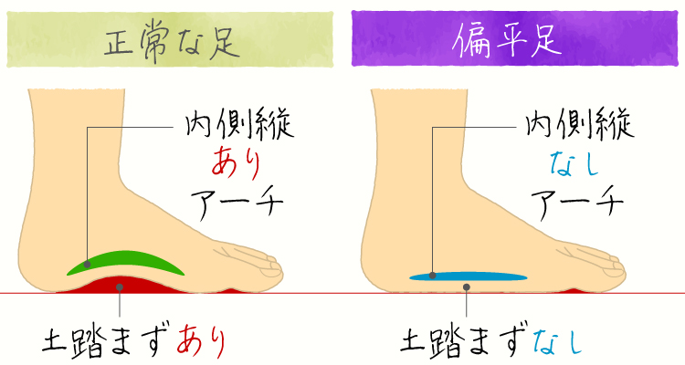 偏平足(へんぺいそく) イメージ