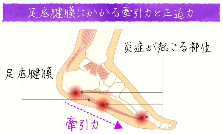 足底腱膜炎 イメージ