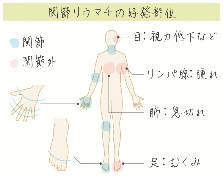 リウマチの進行 イメージ画像