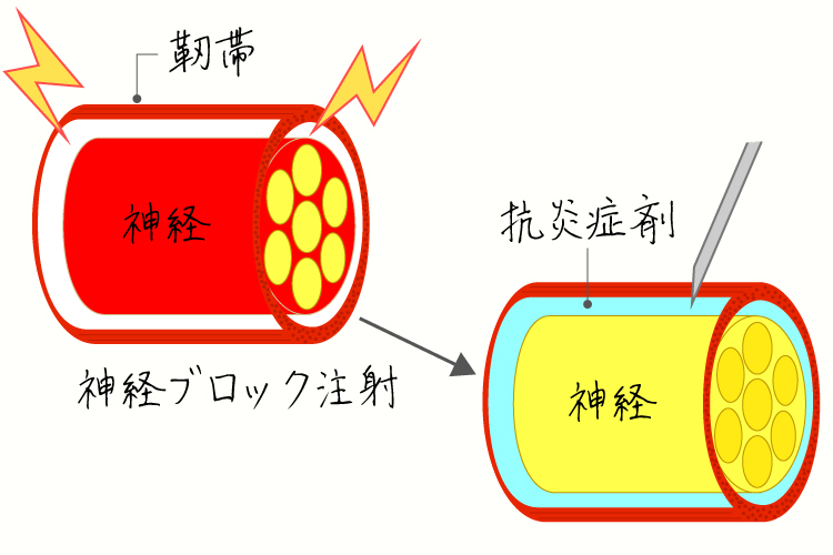 神経ブロック治療イメージ画像