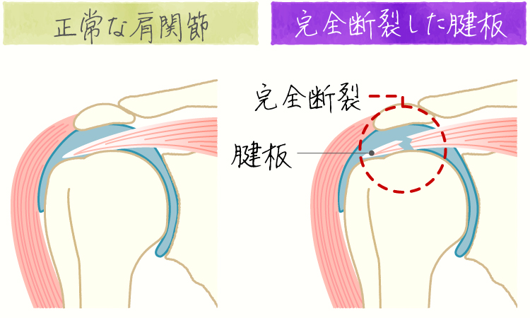 野球肩 イメージ画像