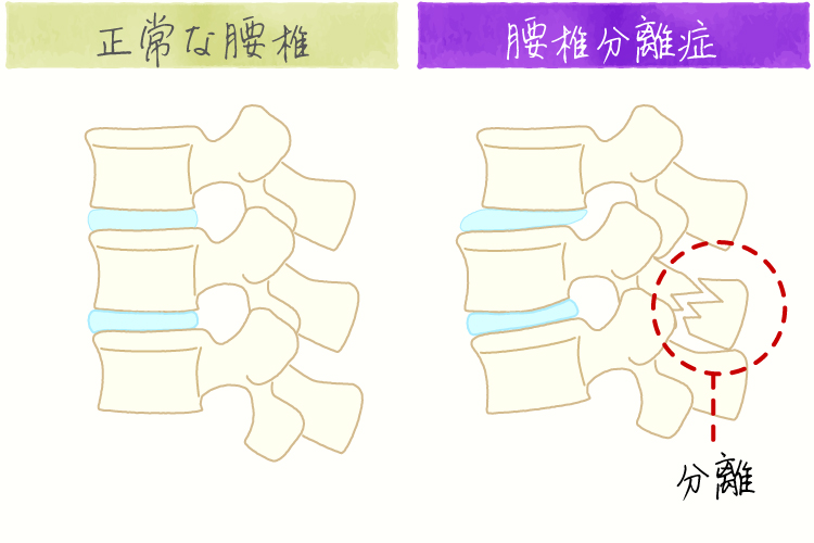 腰椎分離症 イメージ画像