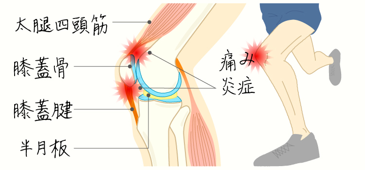 ジャンパー膝 イメージ画像