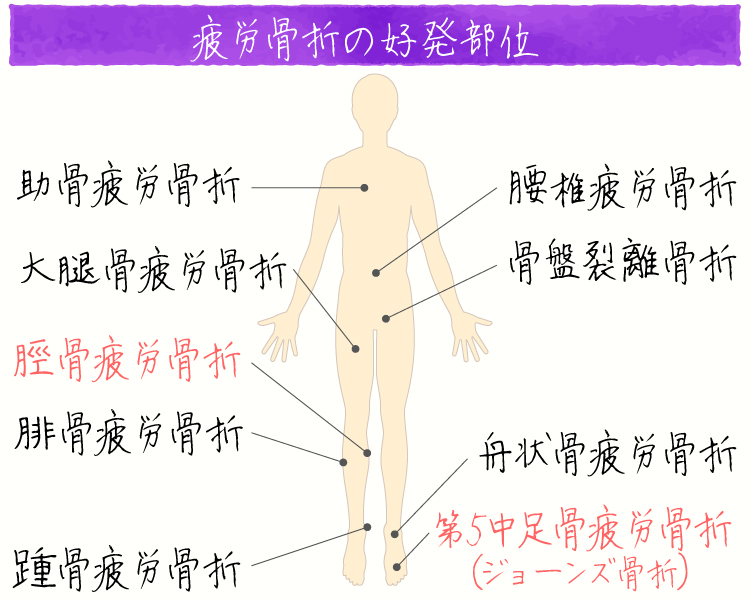 疲労骨折（中足骨・脛骨）イメージ画像