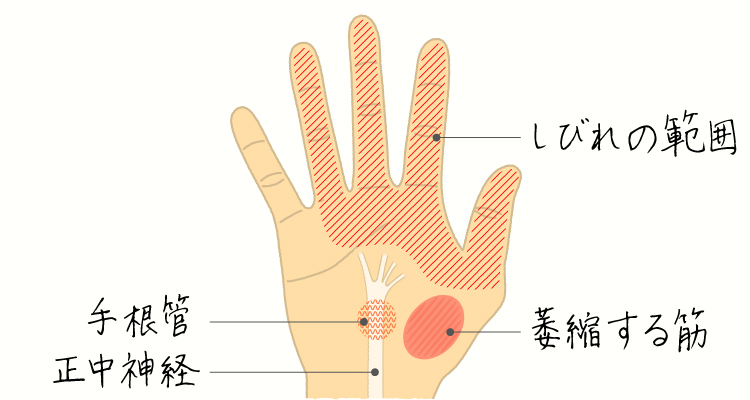 手根管症候群 イメージ